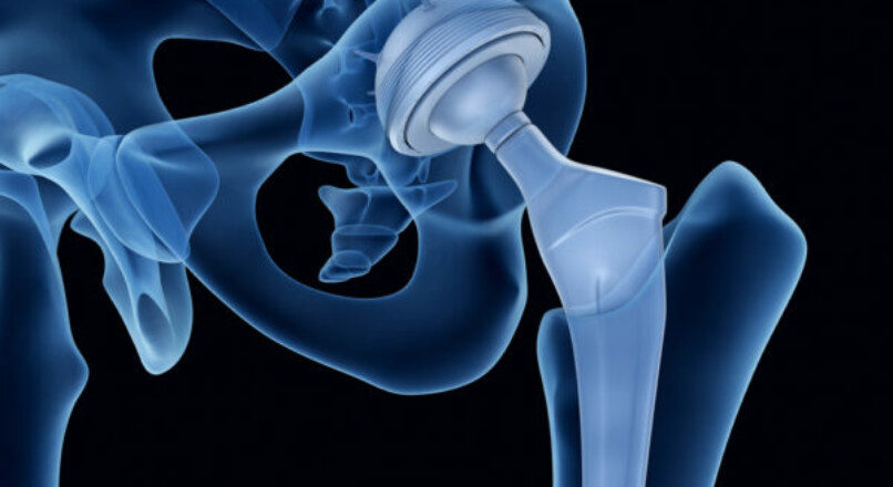 6 Important Long Term Precautions After Hip Replacement Surgery: Your Restrictions and Limitations While at Home