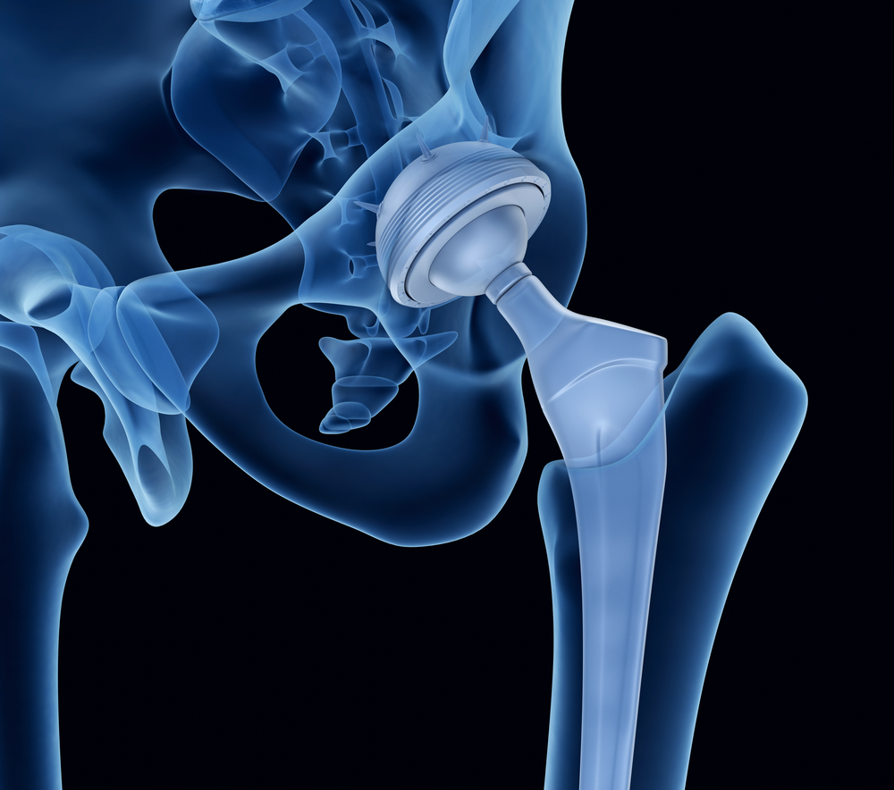 Restrictions After Hip Replacement Surgery