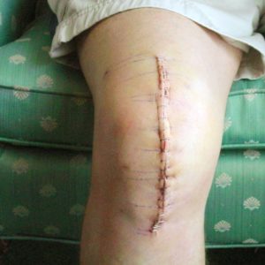 "Total Knee Replacement" by krossbow is licensed under CC BY 2.0