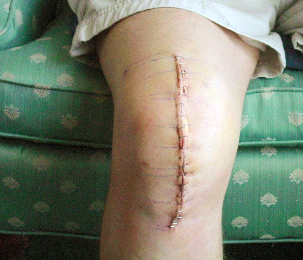 "Total Knee Replacement Surgery" by krossbow is licensed under CC BY 2.0